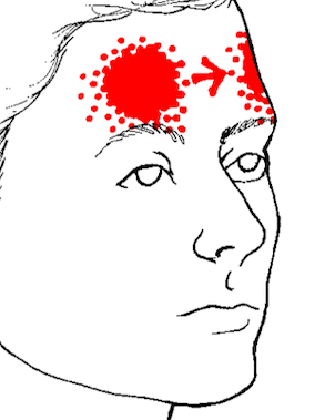 Rdeče področje za glavobol na čelu