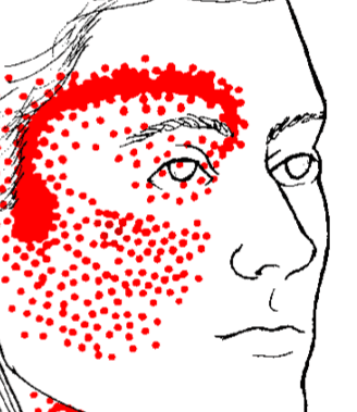 Rdeče področje za glavobol za očmi