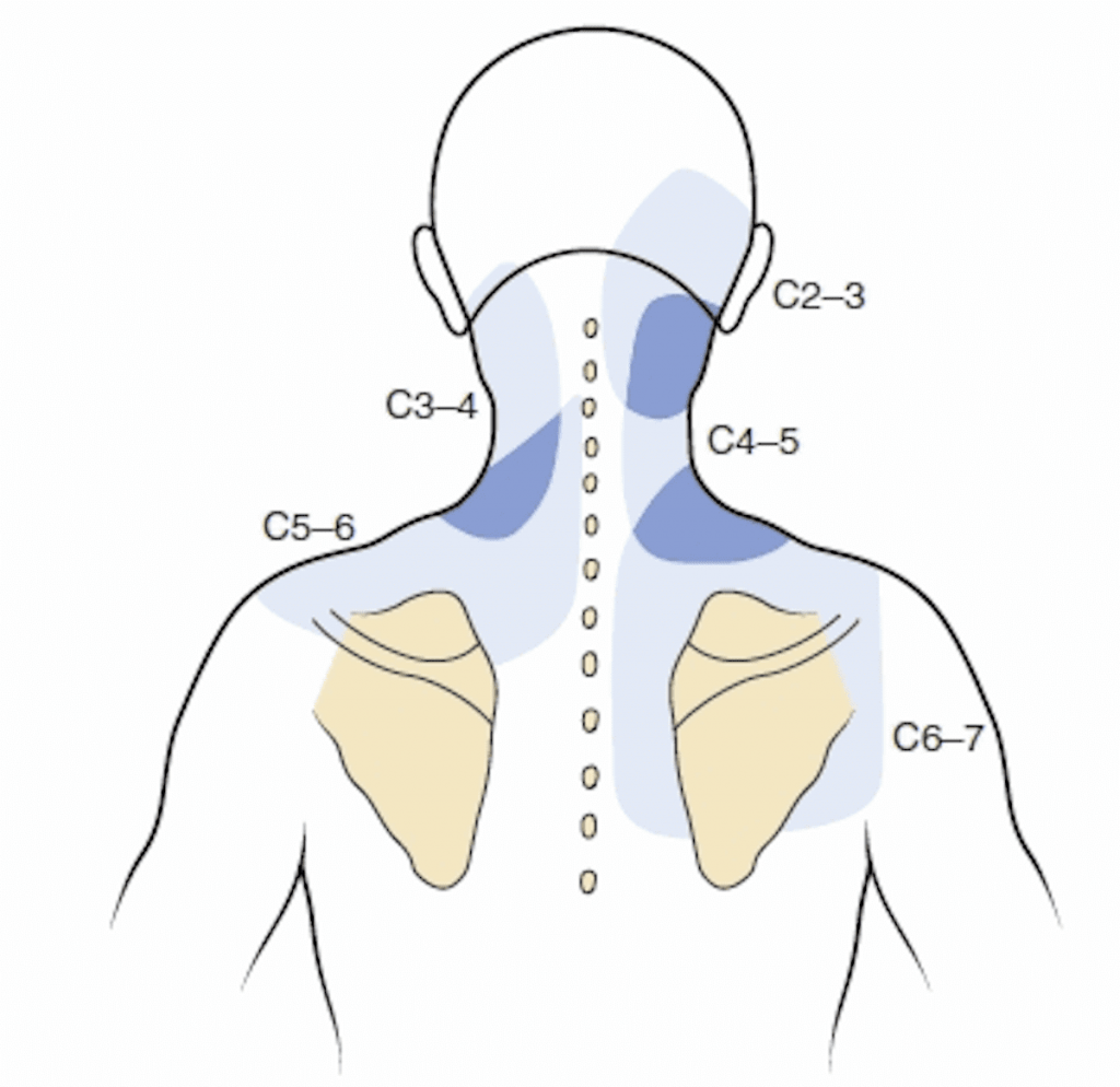 težava v vratu zaradi okvare diska